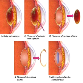 Cataract image 2