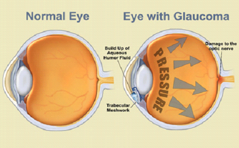 Glaucoma image 1