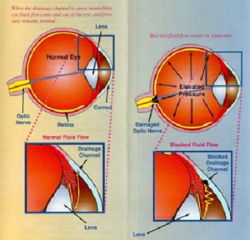 Glaucoma image 2